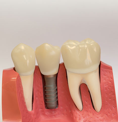 Dental Implants | Clinique Dentaire Dr. S. Sgro & Dr. J. Lang | Greenfield Park, Montreal Dentist