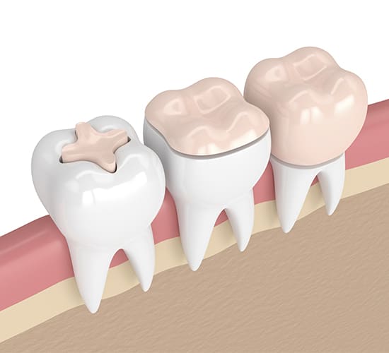 Inlays & Onlays | Clinique Dentaire Dr. S. Sgro & Dr. J. Lang | Greenfield Park, Montreal Dentist